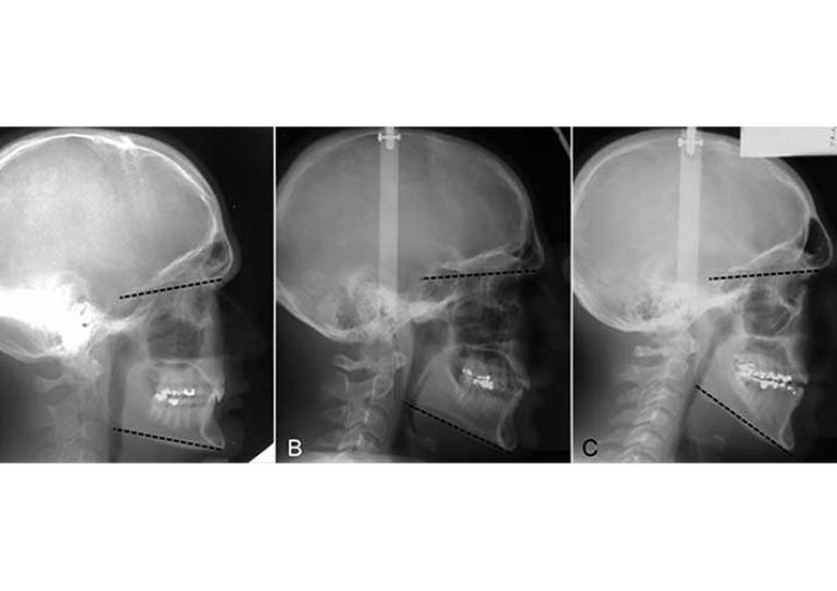 Lateral cephalograms demonstrating examples of hypo‐divergent (A), normo‐divergent (B) and hyper‐divergent (C) facial types.