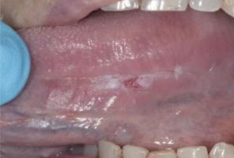 Leukoplakia. Most common precancerous lesion (89%: 618/695)