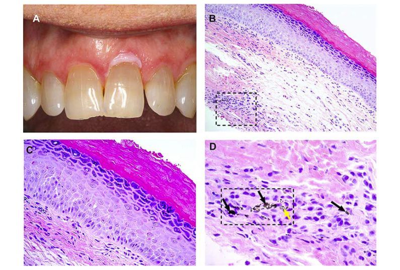 Fig. 1. (A) Clinical image showing a white lesion involving the facial marginal gingiva of tooth #9. (Courtesy of Dr. Reid Lester). (B) Representative photomicrograph showing hyperorthokeratosis and foreign material in the deep lamina propria (square) (hematoxylin and eosin [H&E]; original magnification £ 200). (C) High-power view of the same case shows that the epithelium exhibits dyskeratosis, cellular discohesion, and nuclear pleomorphism limited to the lower one-third of the epithelial thickness—mild dy