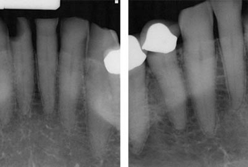 Radiograph of distal D3 approximal lesion on tooth #25. The technique known as SMART could help repair tooth damage and prevent caries without requiring multiple appointments.