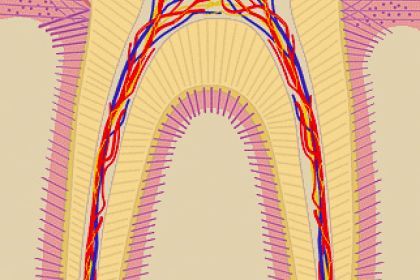 cross-section illustration of tooth with pulpitis